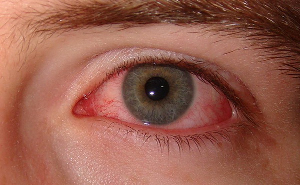 Image depicting redness in one eye, a symptom of dry eyes. Learn about dry eye causes, symptoms, and treatment.