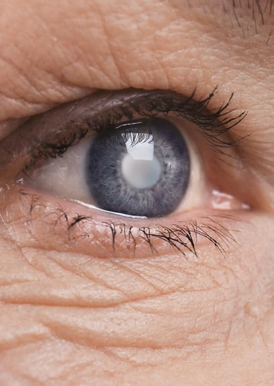 Cataract eye 