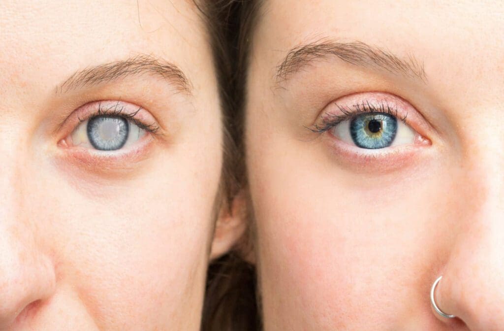 A close up of two eyes side by side, one eye showing a cataract and one eye appearing normal.