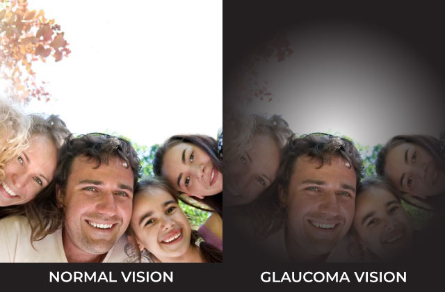 Image compare normal vision vs vision when you are affected by Glaucoma