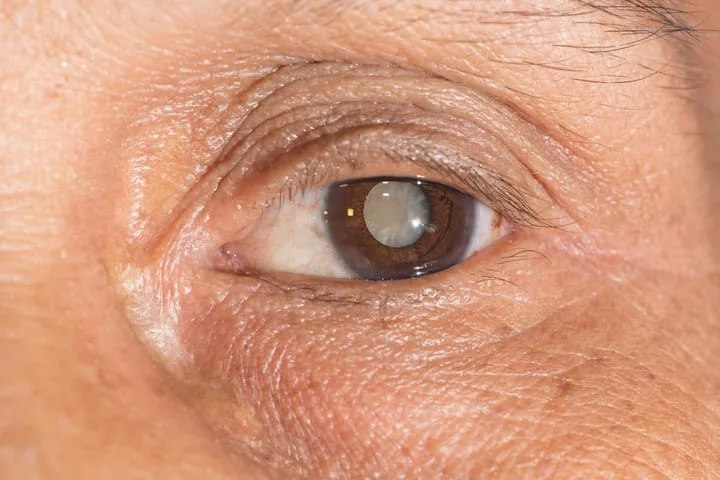 Close-up of an elderly person's eye with a visible cataract, highlighting the cataracts and diabetes connection. Illustrates the impact of diabetes on cataract development and the need for awareness.