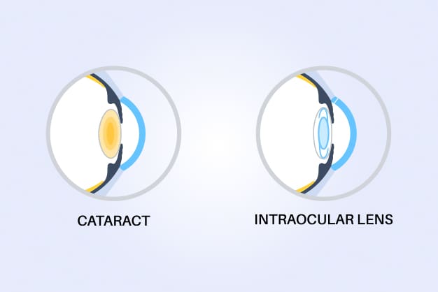 omparison image showing a cataract on the left and an intraocular lens on the right, representing before and after cataract surgery.