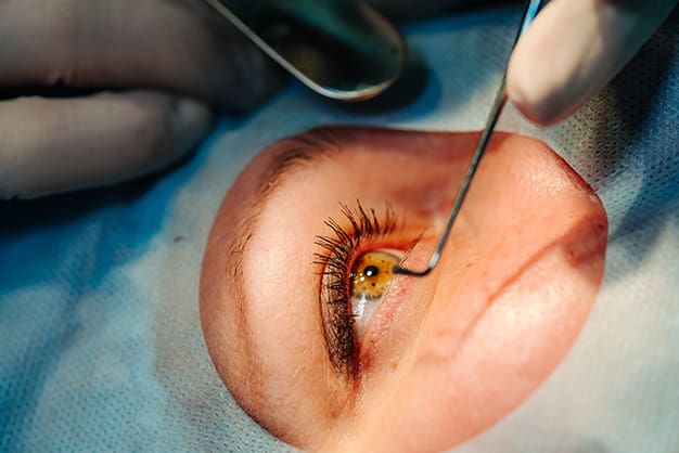 Close-up of an eye during cataract surgery, showing precision care, highlighting its possibility after LASIK.