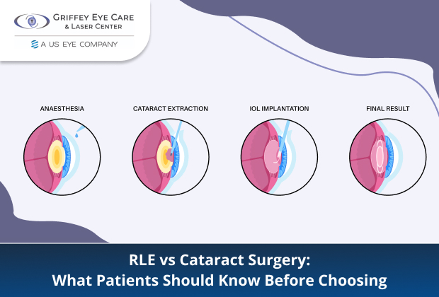 RLE vs Cataract Surgery